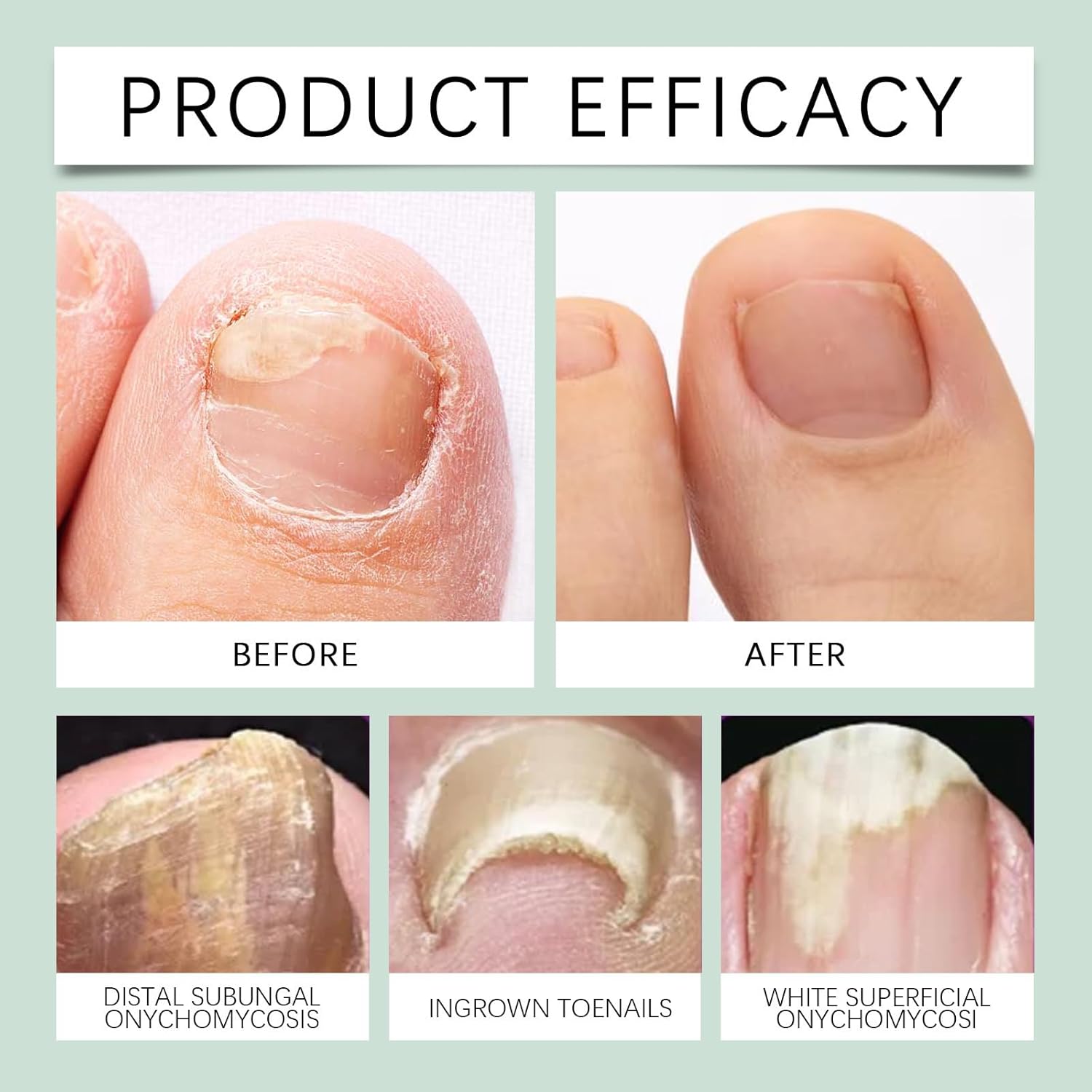 UltraGrow Nail Serum, Nail Growth Serum for Brittle Peeling Breaking Thin Nails, 1 fl.oz